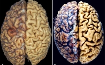 Отмирание клеток головного мозга: диагностика и лечение атрофии
