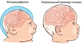 Микроцефалия головного мозга у ребенка