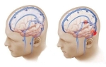 Симптомы и лечение вазоспазма сосудов головного мозга