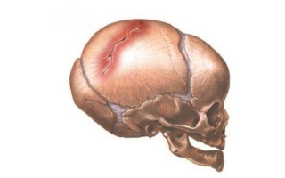 Перелом костей свода и основания черепа
