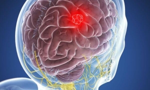 Диагностика опухоли головного мозга: как выявить патологию