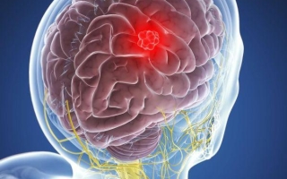 Диагностика опухоли головного мозга: как выявить патологию