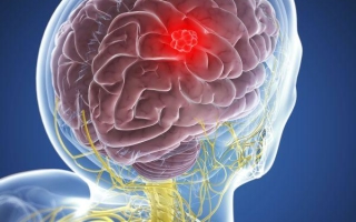 Опухоль головного мозга глиобластома: симптомы, стадии, как лечить