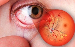 Что такое ангиопатия сетчатки глаза