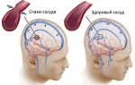 Что такое спазм сосудов головного мозга
