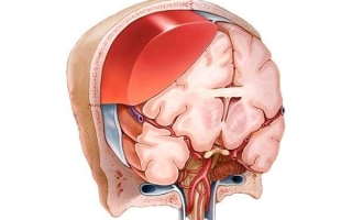 Причины и последствия субдуральной гематомы головного мозга