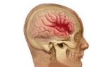 Признаки и последствия обширного кровоизлияния в мозг