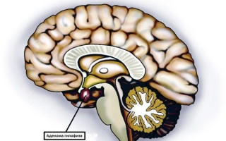 Новообразование головного мозга: аденома гипофиза