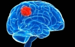 Опухоль головного мозга астроцитома: причины, симптомы, лечение
