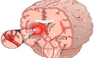 Лопнул сосуд в головном мозге: признаки, лечение, последствия