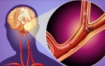 Симптомы и лечение транзиторной ишемической атаки