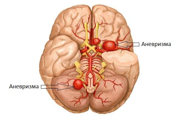 аневризма сосудов головного мозга