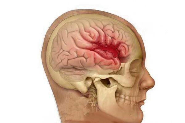 кровоизлияние в мозг