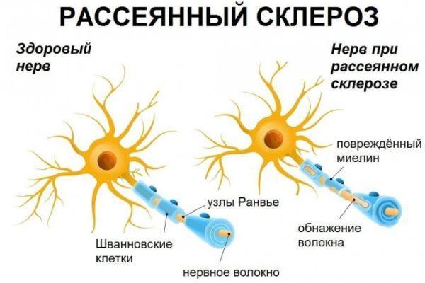 нерв при рассеянном склерозе