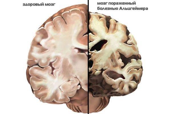 патология мозга
