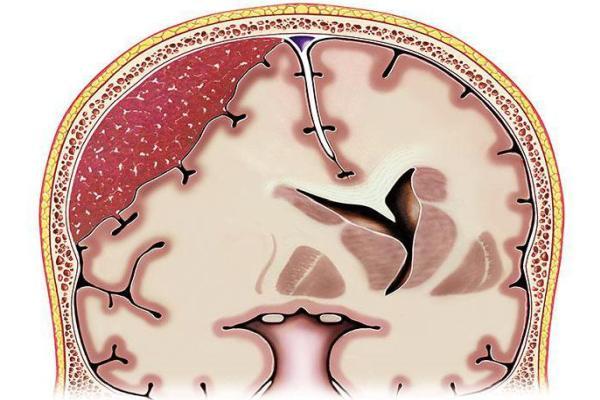 гематома в мозге